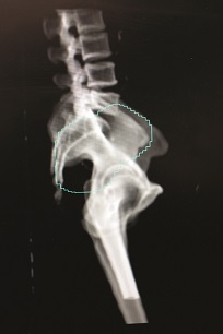 Royal Marsden cancer X ray